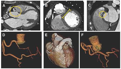 A Challenging Combination: Anomalous Left Anterior Descending Coronary Artery, Myocardial Bridging, and Endothelial Dysfunction